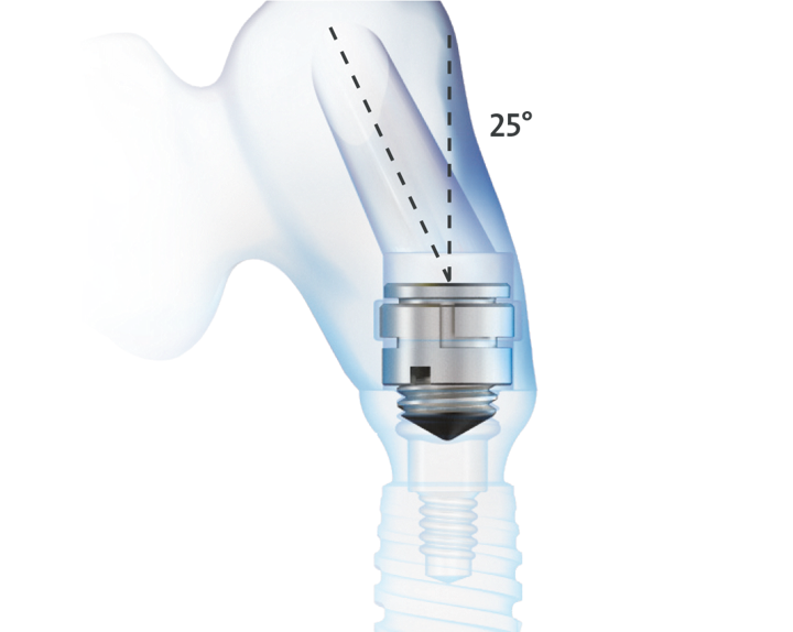 Angulated Access Solutions | Dental customized prosthetics | Anthogyr